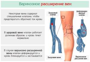 Варикоз Признаки Заболевания