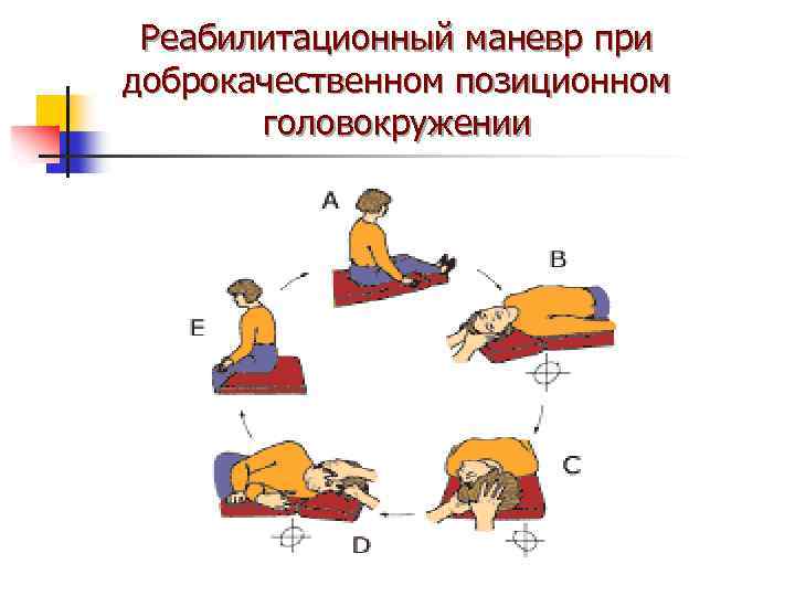 Маневр эпли при головокружении схема