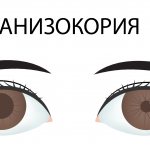 Анизокория