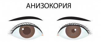 Anisocoria