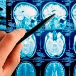 Астроцитома