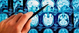 Астроцитома