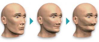 Jaw bone atrophy