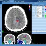 Безоперационное лечение астроцитомы — КиберНожом