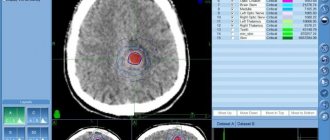 Безоперационное лечение астроцитомы — КиберНожом