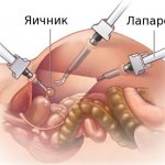 Билатеральная овариэктомия