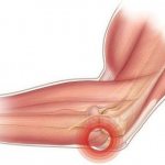 боль в локте при разгибании