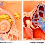 Болезнь Меньера