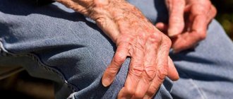 Parkinson's disease