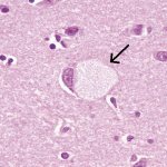 болезнь тея сакса фото