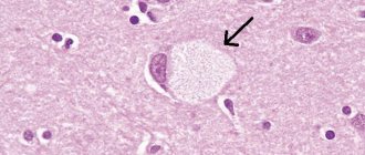 Tay Sachs disease photo
