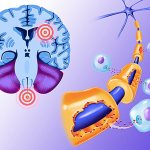 Демиелинизирующее заболевание головного мозга