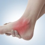 Distal polyneuropathy of the lower extremities