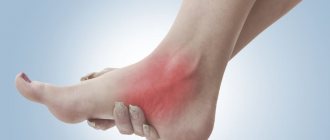 Distal polyneuropathy of the lower extremities