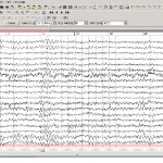 Эхоэнцефалограмма
