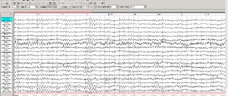 Echoencephalogram