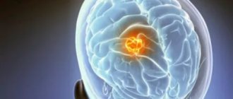 Ependymoma of the brain