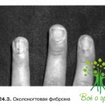 Факоматоз | Детская офтальмология