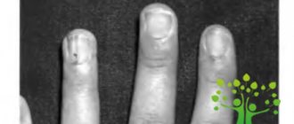Phakomatosis | Pediatric ophthalmology