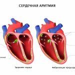 Фибрилляция предсердий.jpg