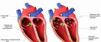 Atrial fibrillation.jpg