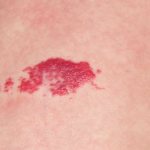 hemangioma photo in adults