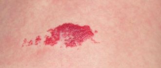 гемангиома фото у взрослых