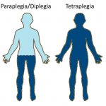 Гемиплегия - фото