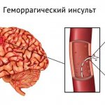 Hemorrhagic stroke