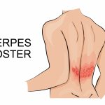 Герпес Зостер.jpg