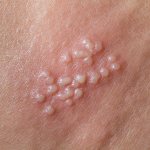 герпетическая сыпь