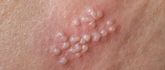 herpetic rash