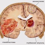Glioblastoma of the brain: how long do you live with it?
