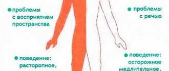 инсульт головного мозга