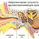 Как и чем лечить кохлеарный неврит слухового нерва. нейросенсорная тугоухость (кохлеарный неврит): причины, симптомы и лечение кохлеарный неврит слухового нерва симптомы лечение