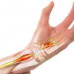 карпальный синдром.jpg