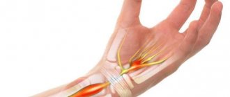 карпальный синдром.jpg