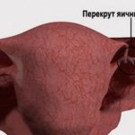 Киста яичника