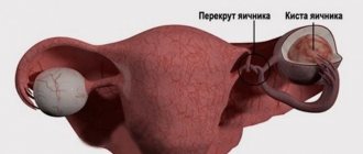 Киста яичника