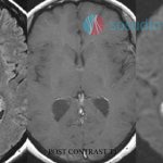 Кисты сосудистых сплетений на снимках МРТ