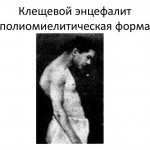 клещевой энцефалит