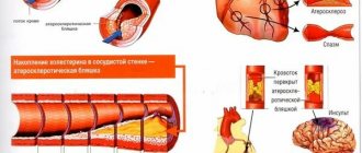 treatment of vascular atherosclerosis with folk remedies with a glass of boiling water