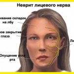 Лицевой неврит