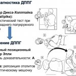 Epley maneuver for dizziness. How to do exercises, videos, reviews 