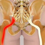Массаж не применяют при обострении ишиаса