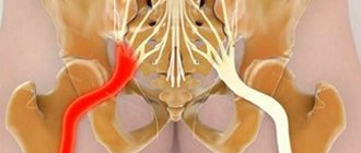 Massage is not used for exacerbation of sciatica