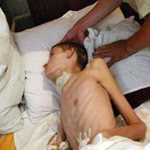 Tuberculous meningitis