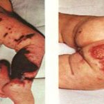 менингококцемия у детей (фото)