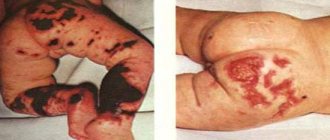 менингококцемия у детей (фото)