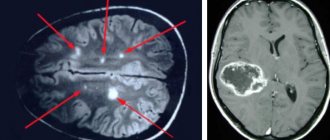 Metastases and brain tumor on MRI